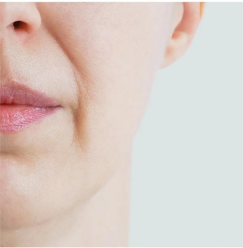 dermal filler wholesale
